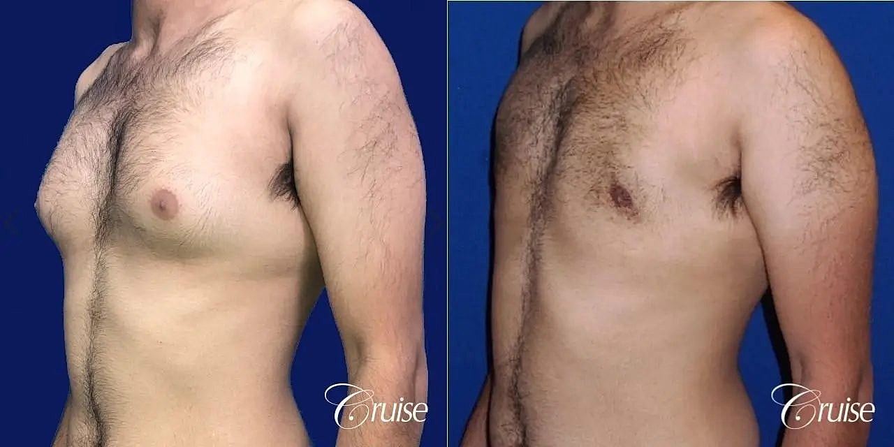 Gynecomastia Surgery Before & After