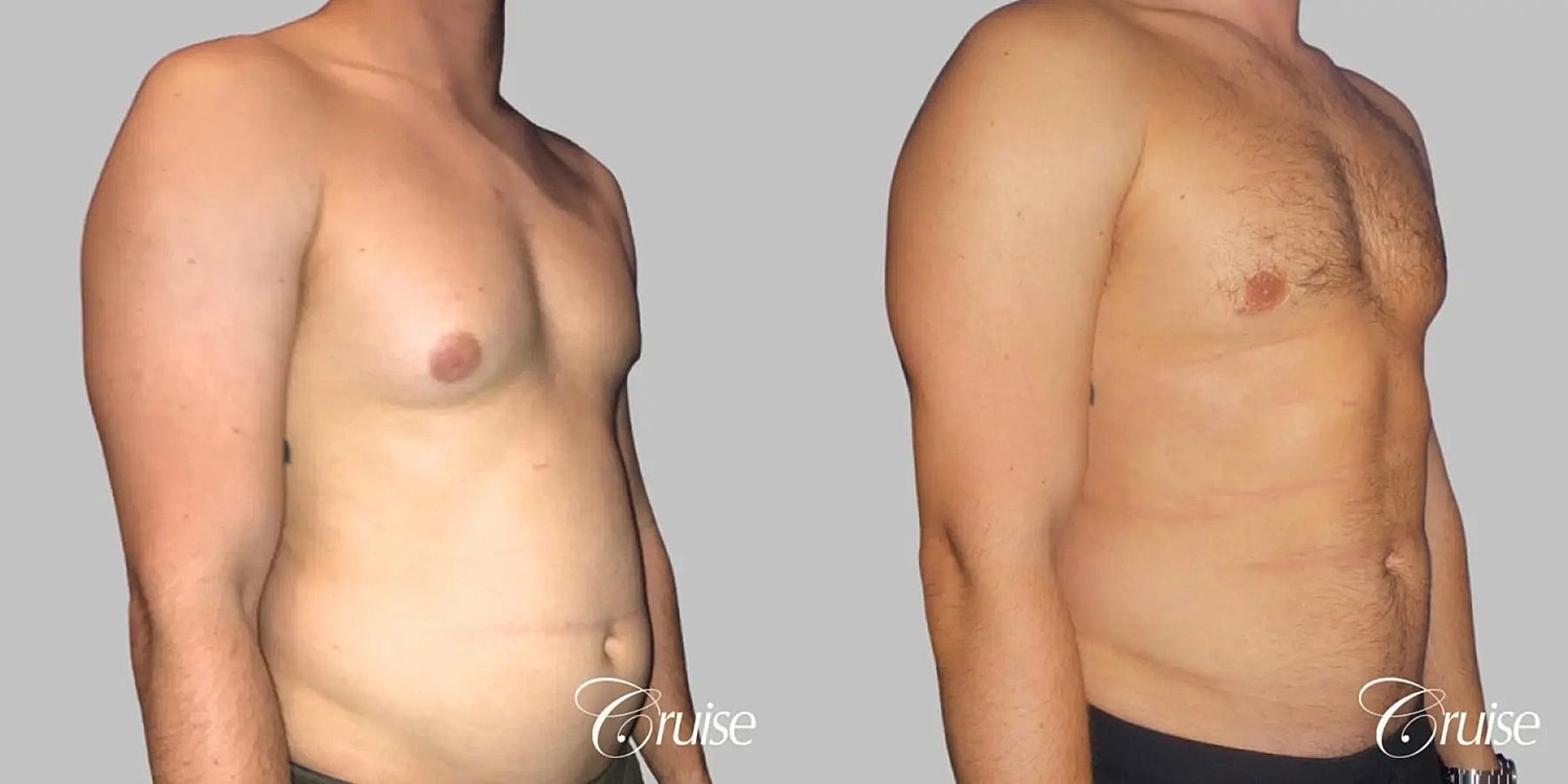 Gynecomastia Surgery Before & After