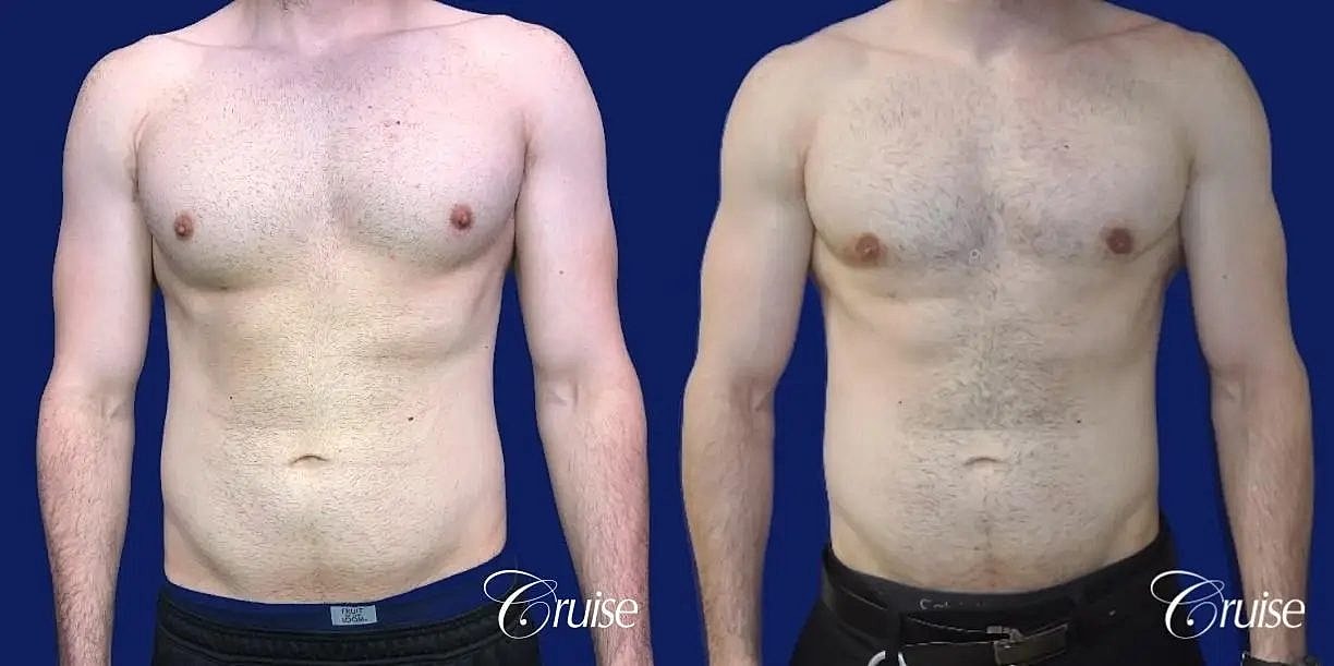 Gynecomastia Surgery Before & After