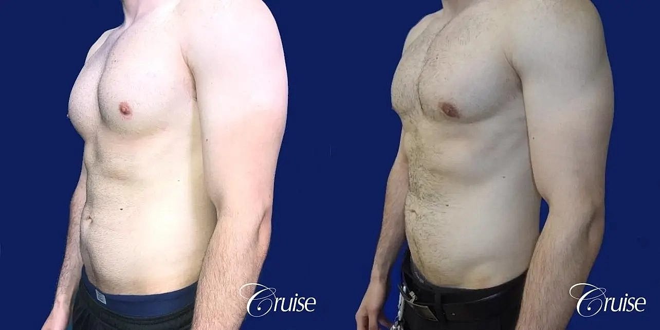 Gynecomastia Surgery Before & After