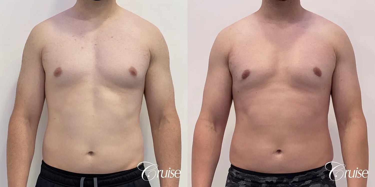 Gynecomastia Surgery Before & After