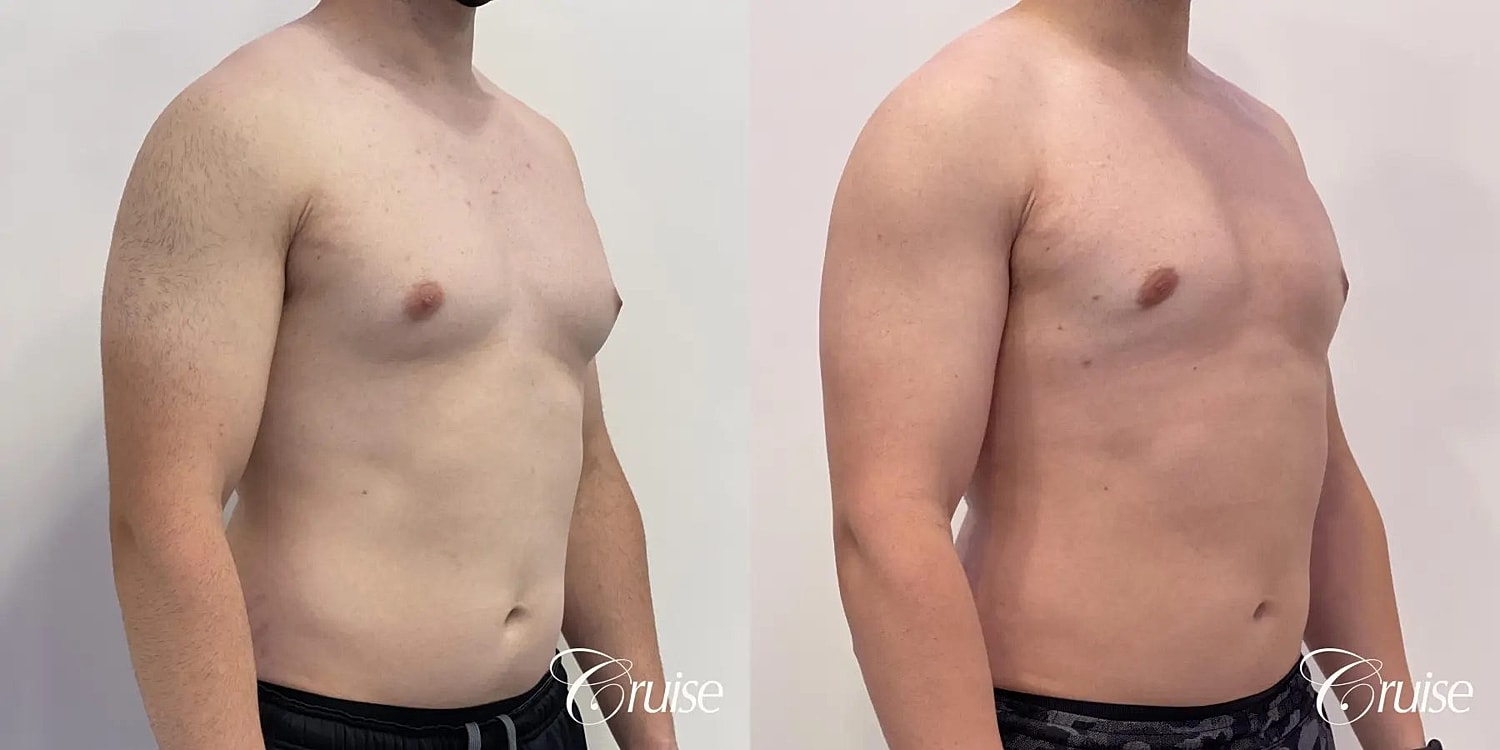 Gynecomastia Surgery Before & After