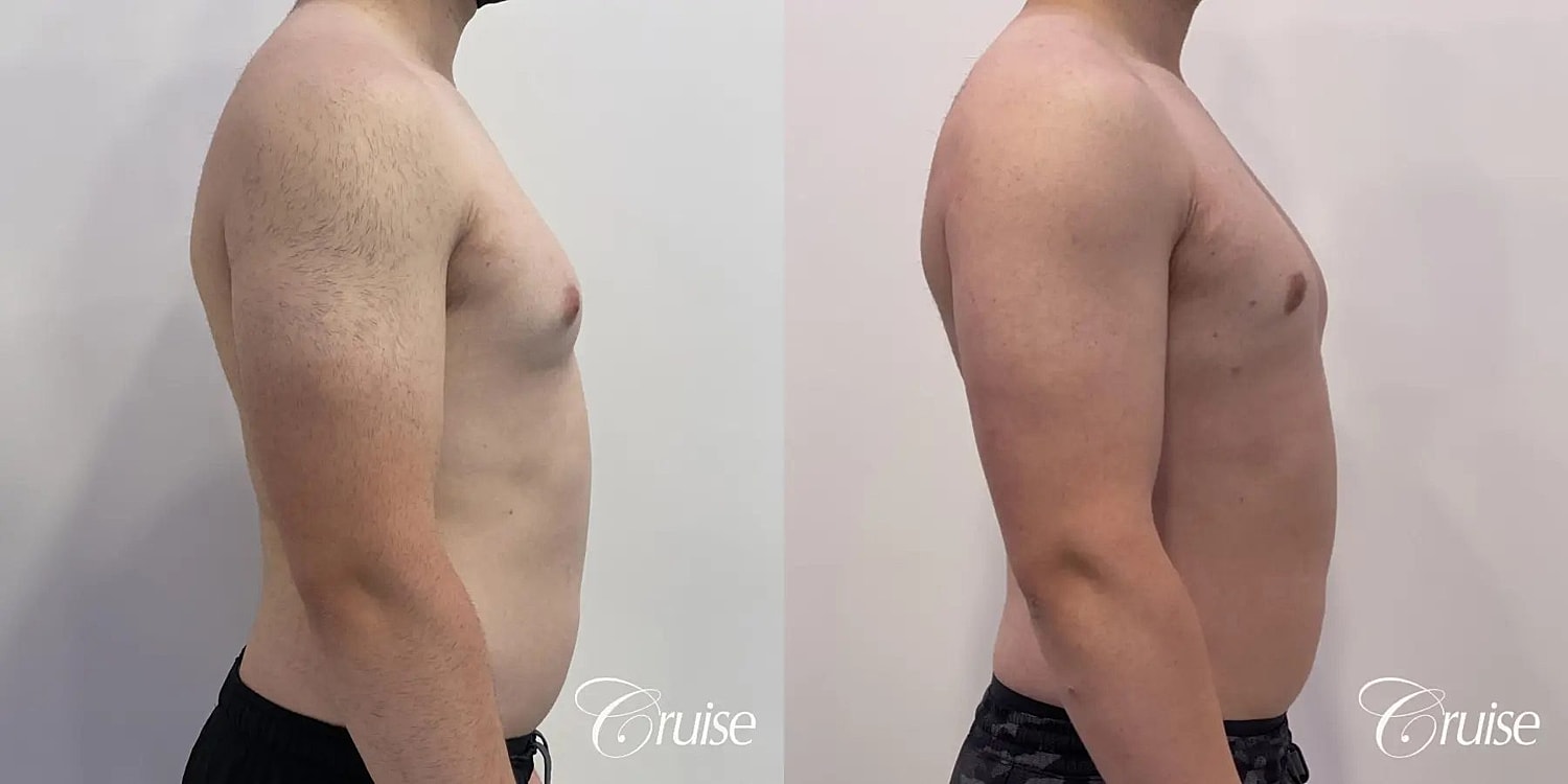 Gynecomastia Surgery Before & After