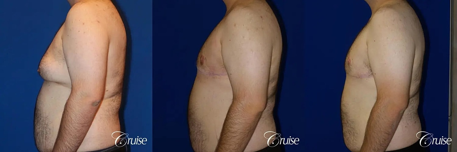 Gynecomastia Surgery Before & After