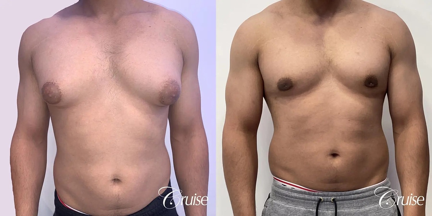 Gynecomastia Surgery Before & After