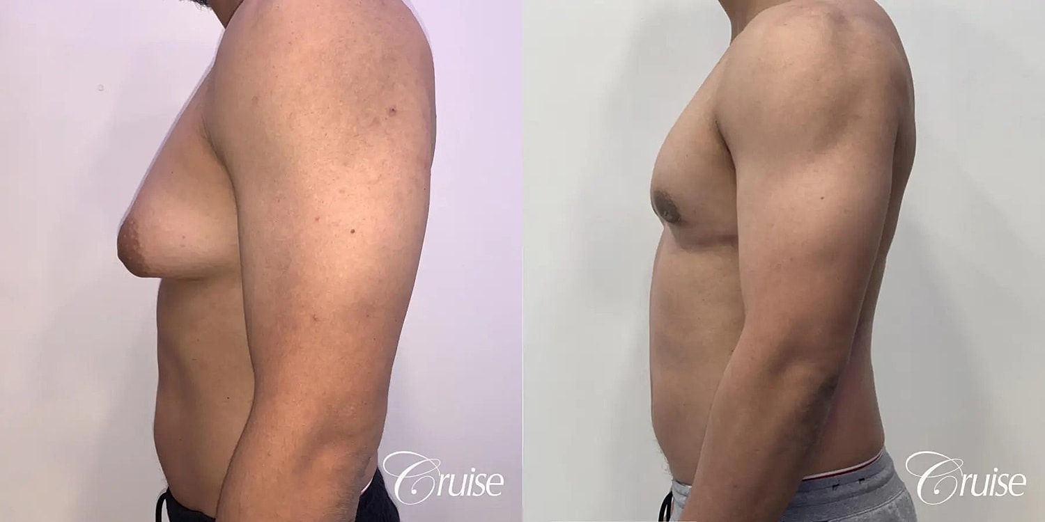 Gynecomastia Surgery Before & After