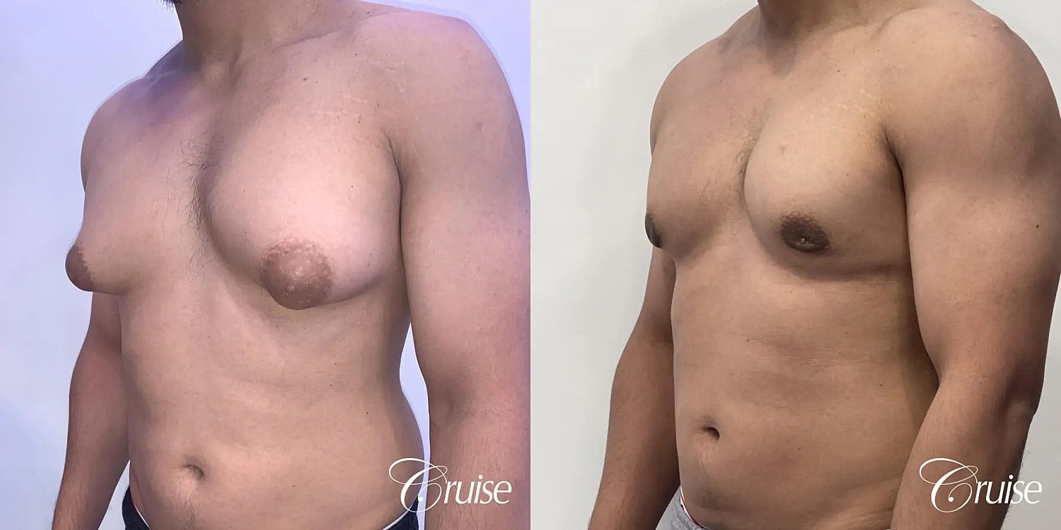 Gynecomastia Surgery Before & After