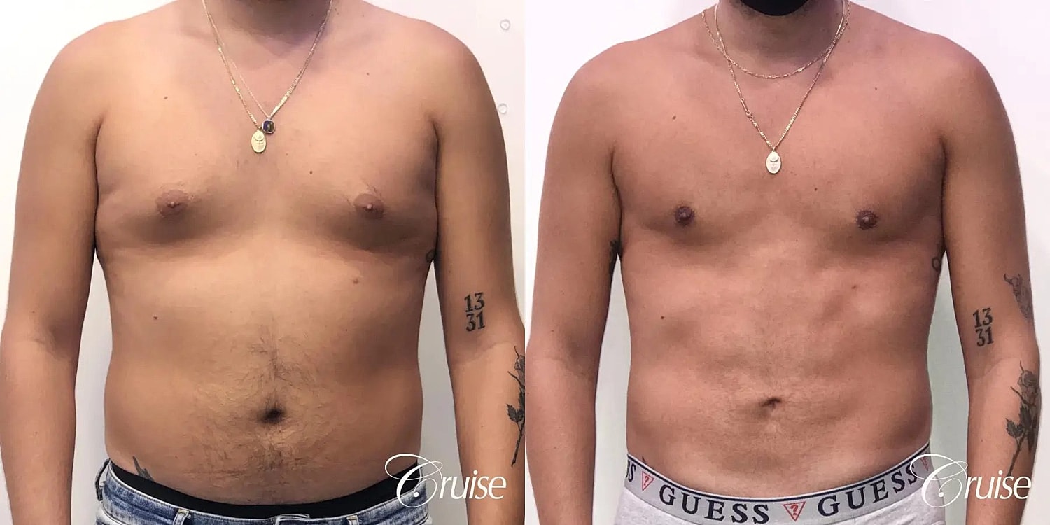 Gynecomastia Surgery Before & After