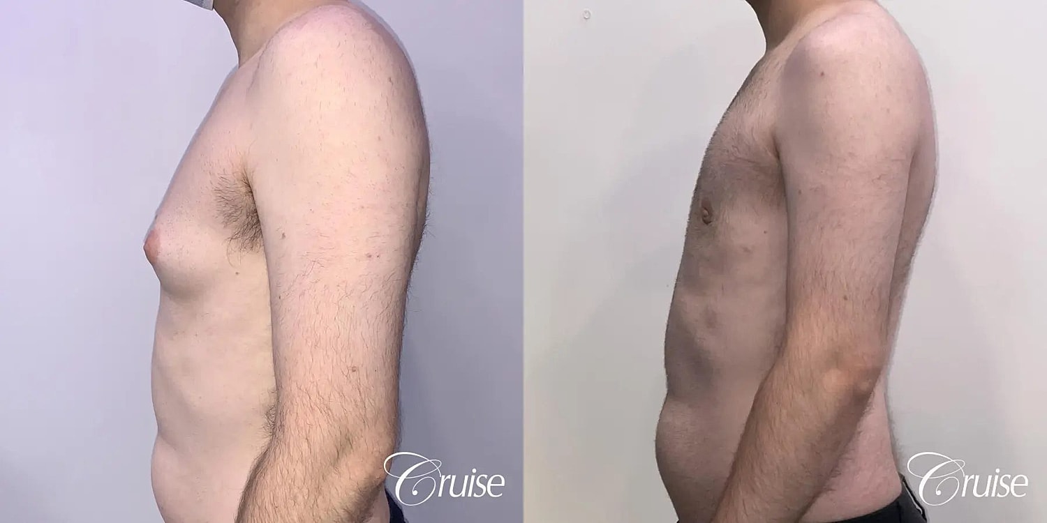 Gynecomastia Surgery Before & After
