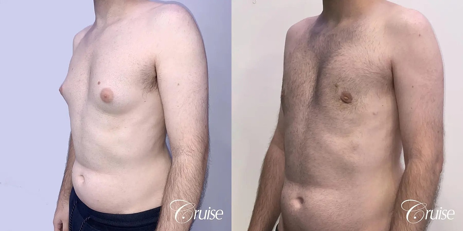 Gynecomastia Surgery Before & After