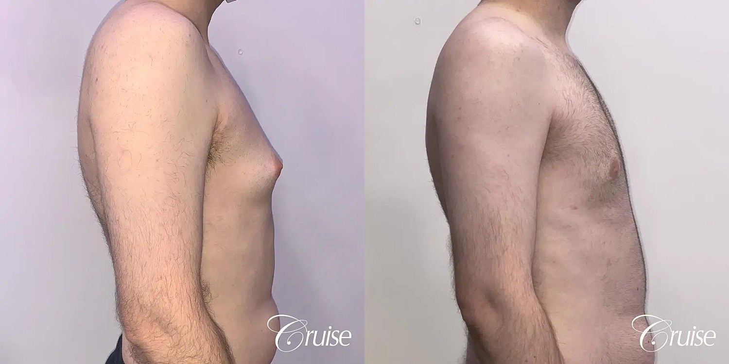 Gynecomastia Surgery Before & After