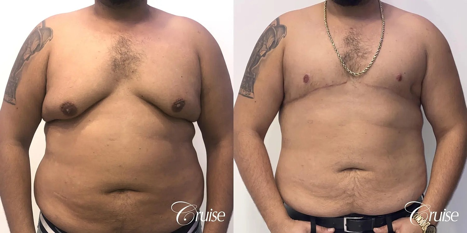 Gynecomastia Surgery Before & After