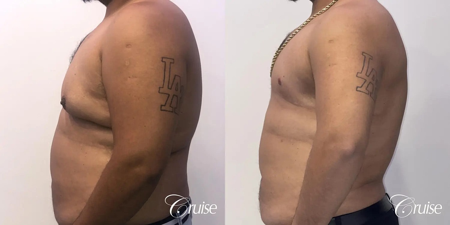 Gynecomastia Surgery Before & After