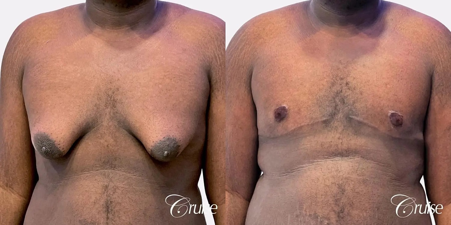Gynecomastia Surgery Before & After