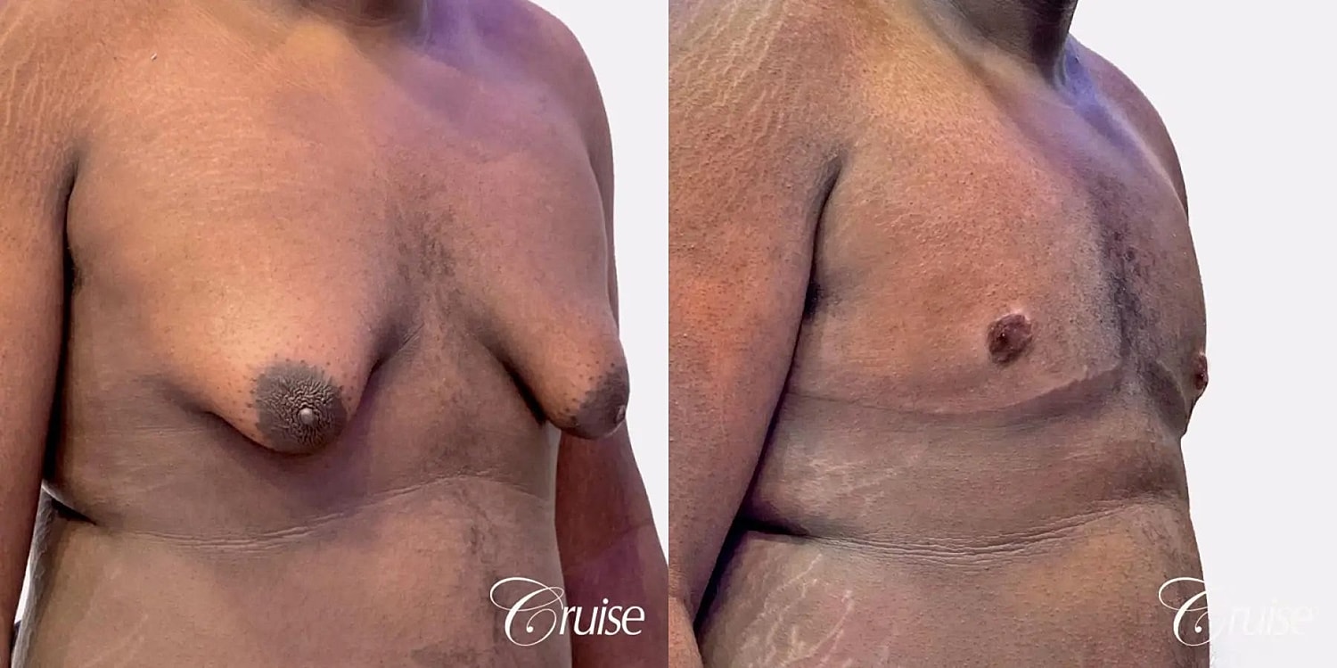 Gynecomastia Surgery Before & After