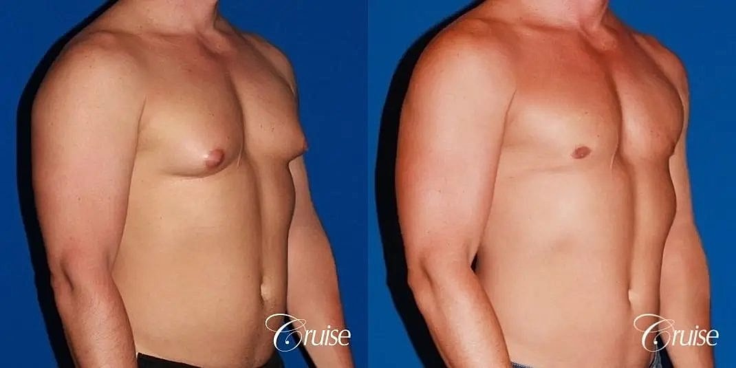 Gynecomastia Surgery Before & After