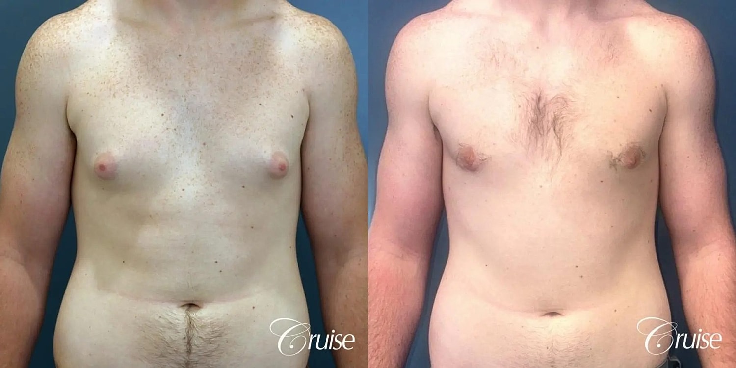 Gynecomastia Surgery Before & After