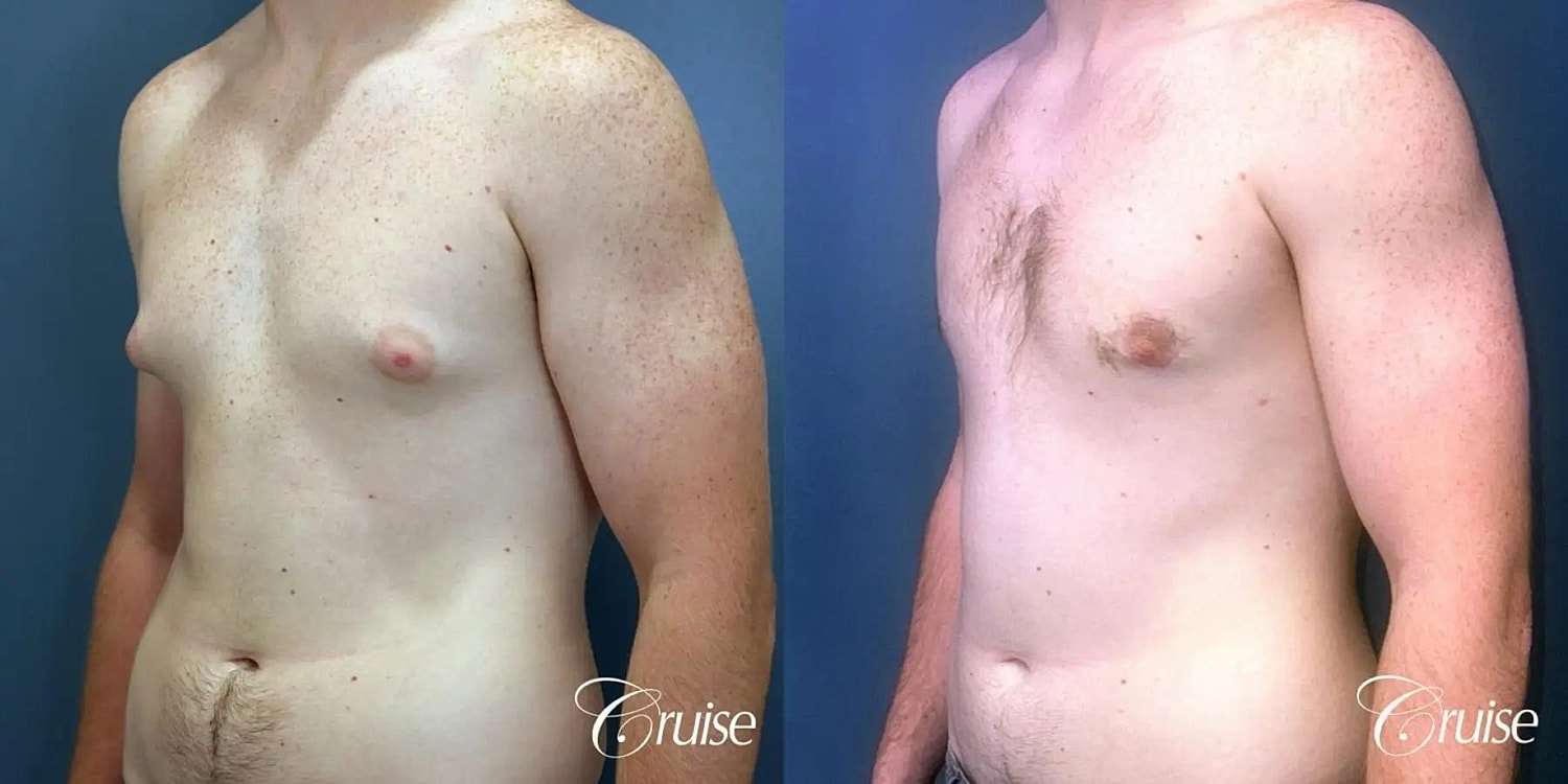 Gynecomastia Surgery Before & After