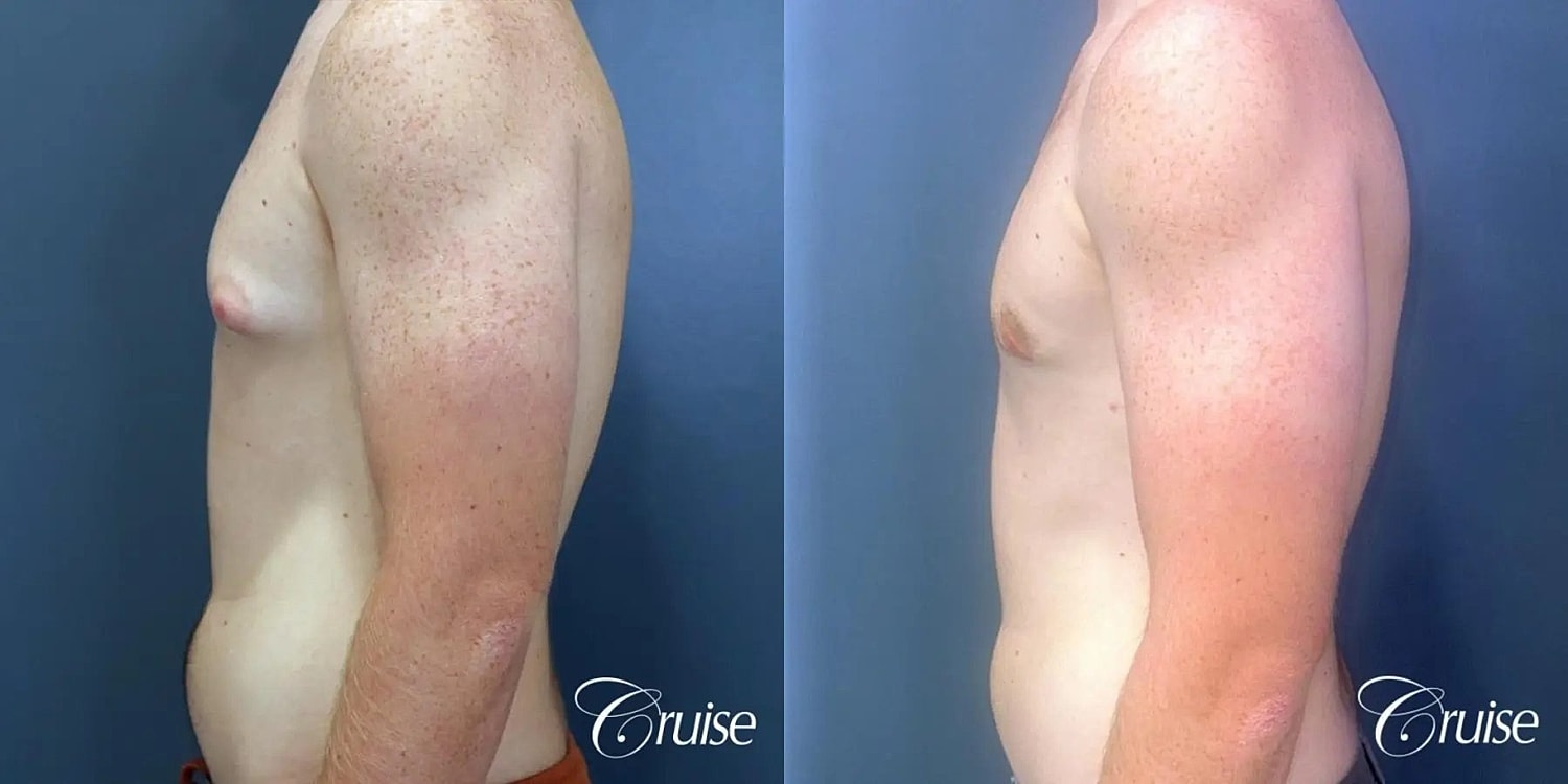 Gynecomastia Surgery Before & After