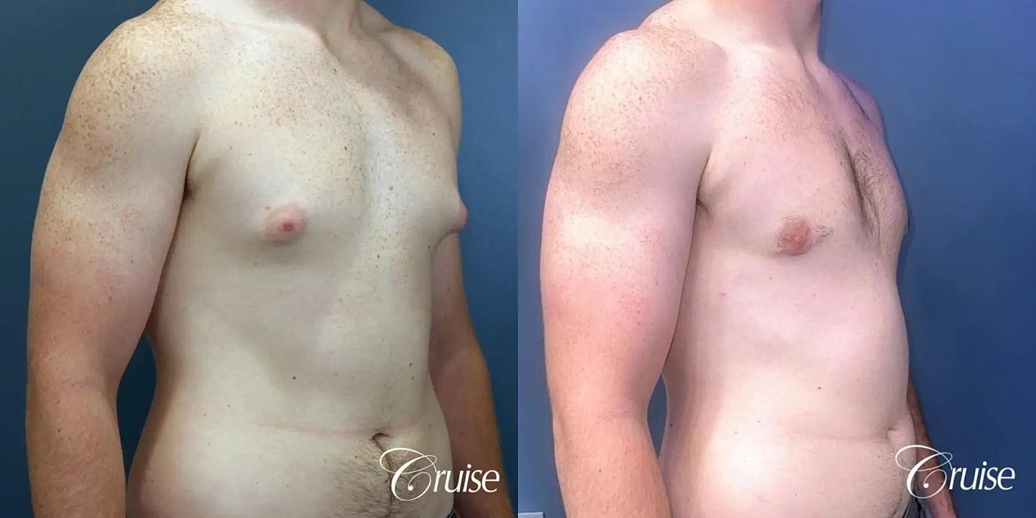Gynecomastia Surgery Before & After