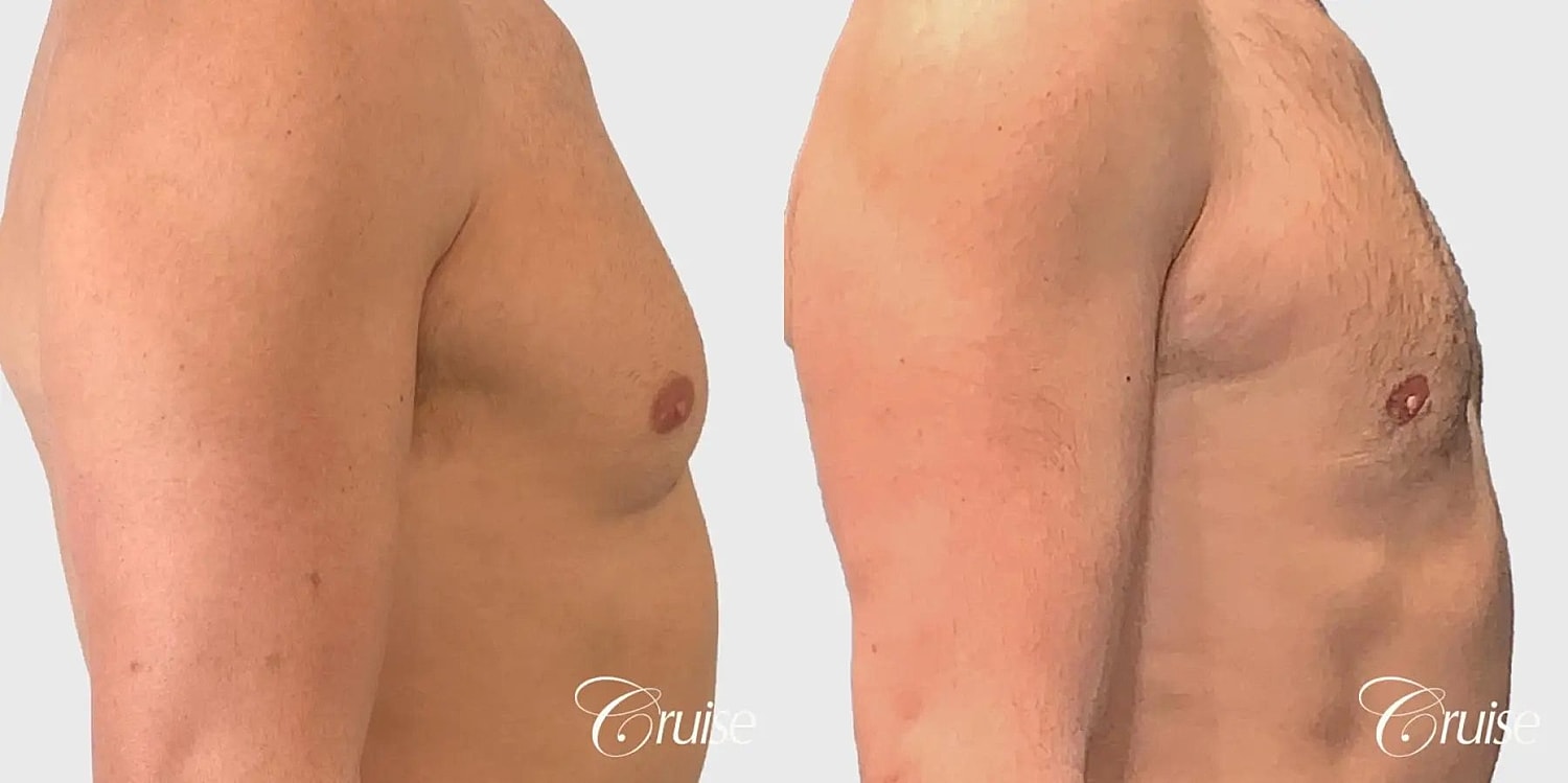 Gynecomastia Surgery Before & After
