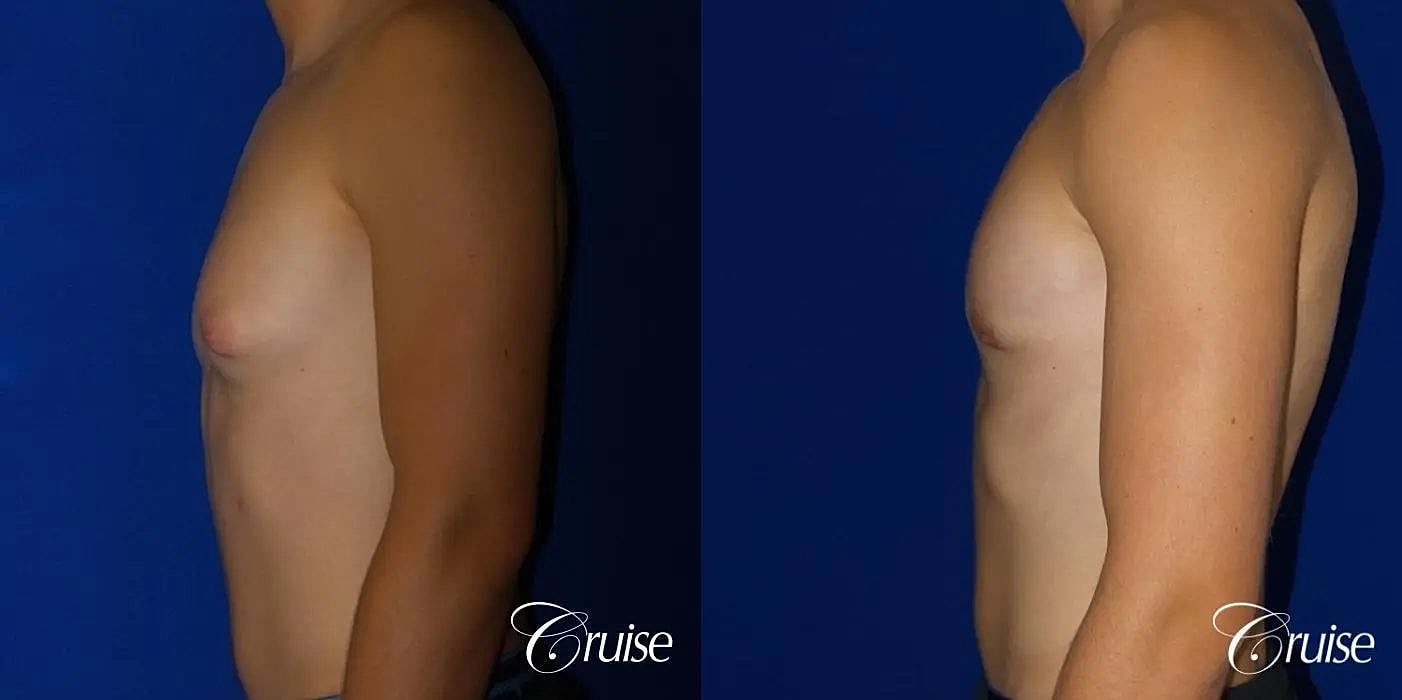Gynecomastia Surgery Before & After