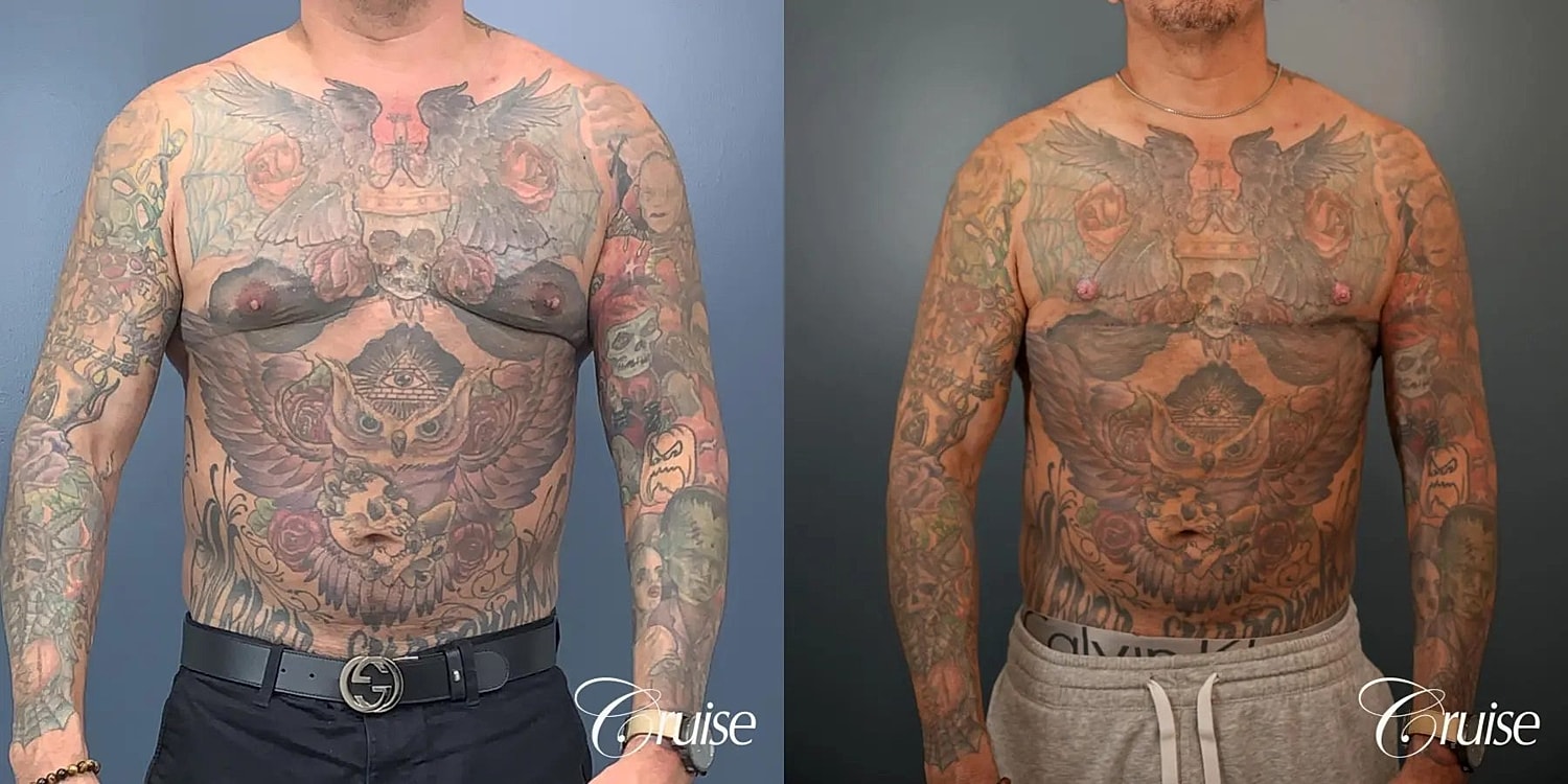 Gynecomastia Surgery Before & After