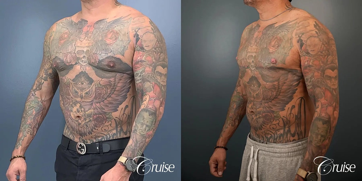Gynecomastia Surgery Before & After