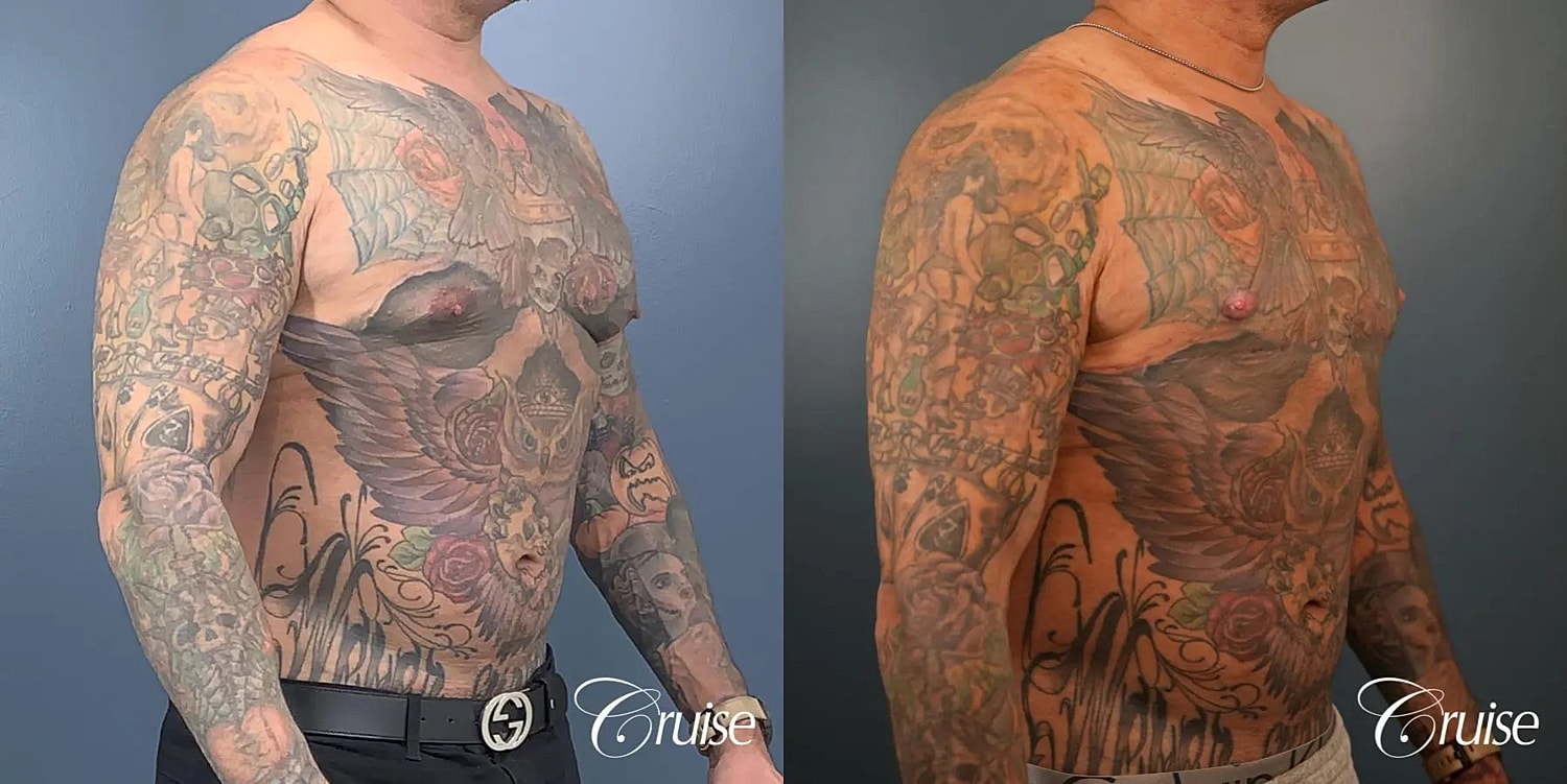 Gynecomastia Surgery Before & After