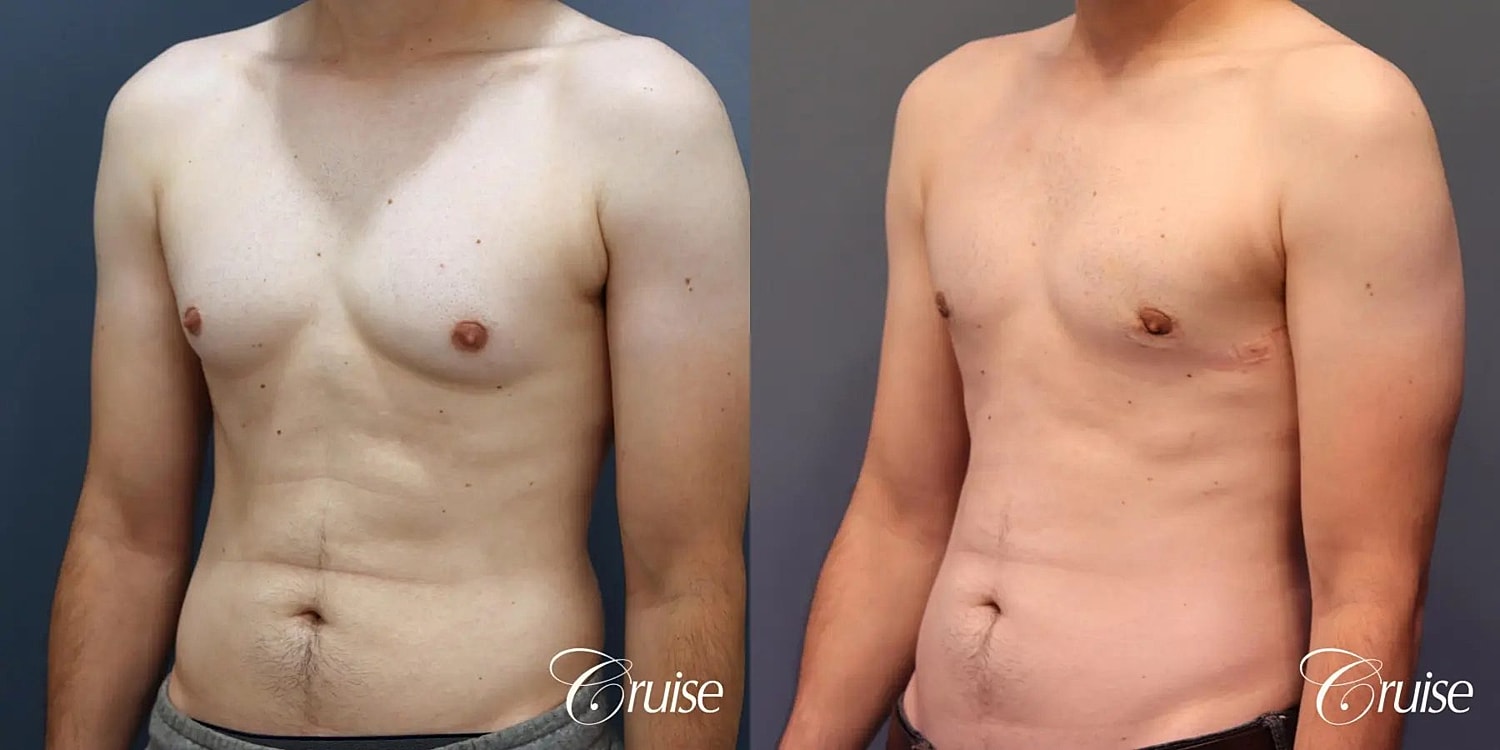Gynecomastia Surgery Before & After