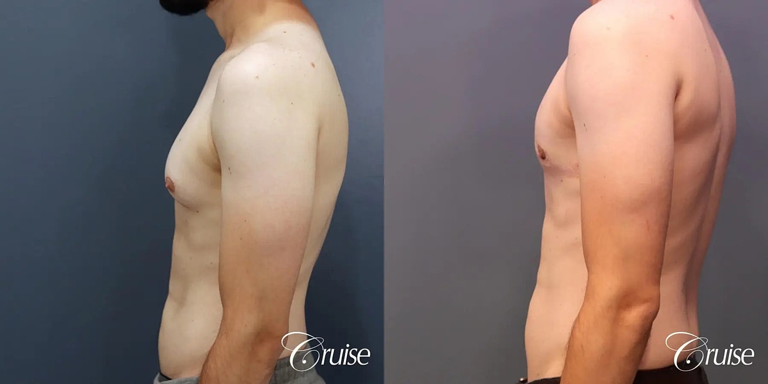 Gynecomastia Surgery Before & After