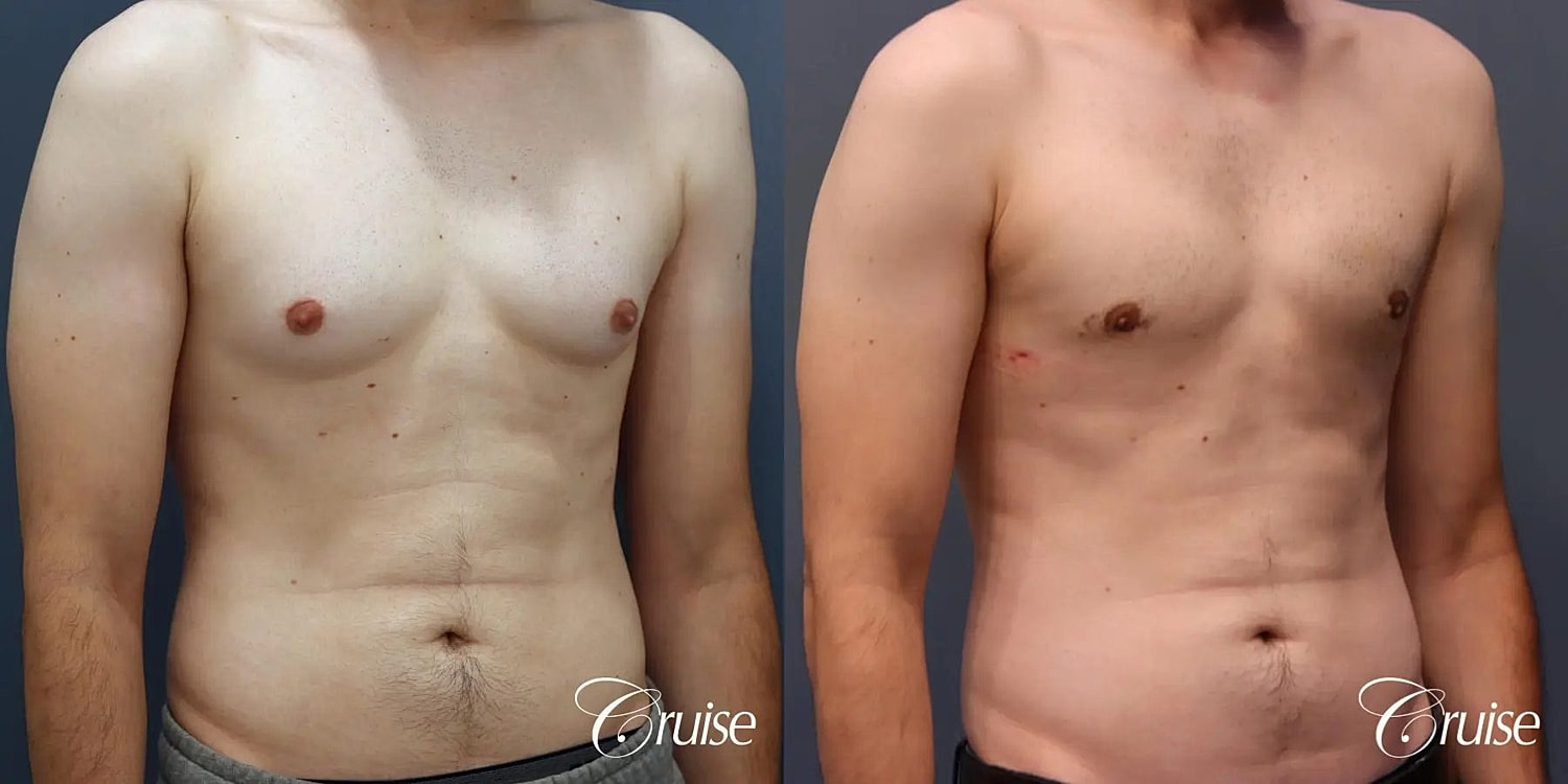 Gynecomastia Surgery Before & After