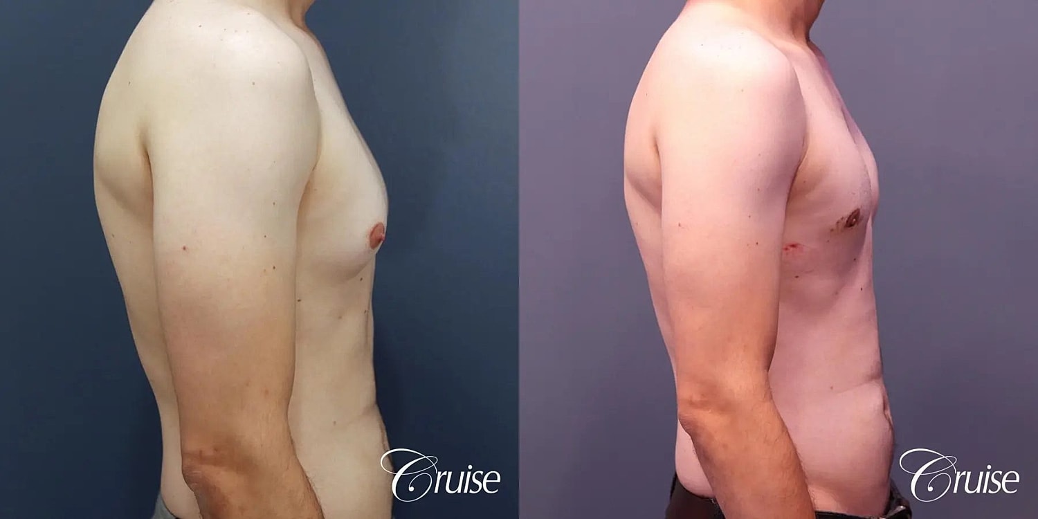 Gynecomastia Surgery Before & After