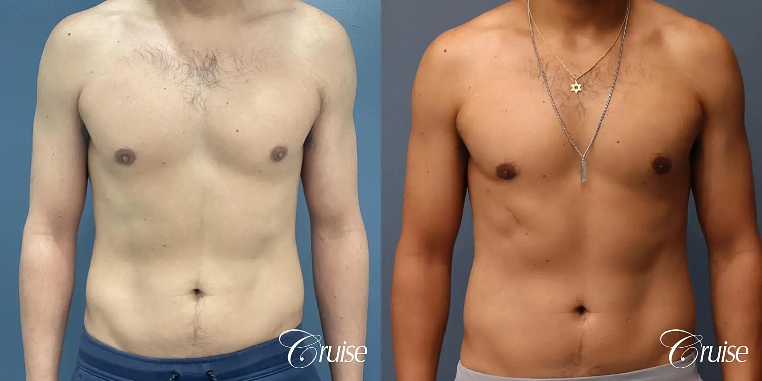 Gynecomastia Surgery Before & After