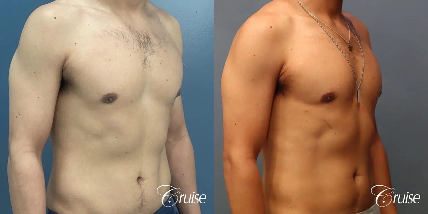 Gynecomastia Surgery Before & After