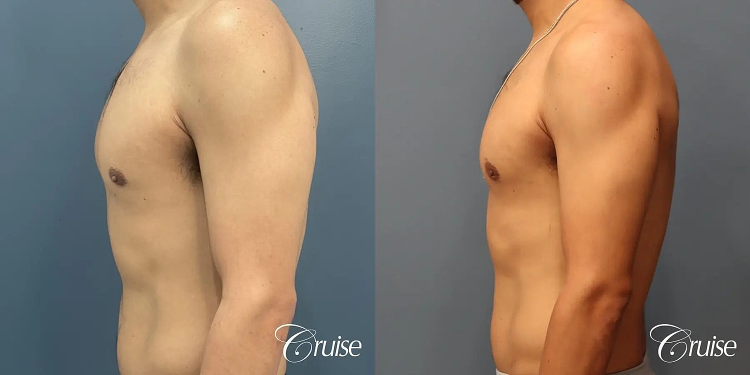 Gynecomastia Surgery Before & After