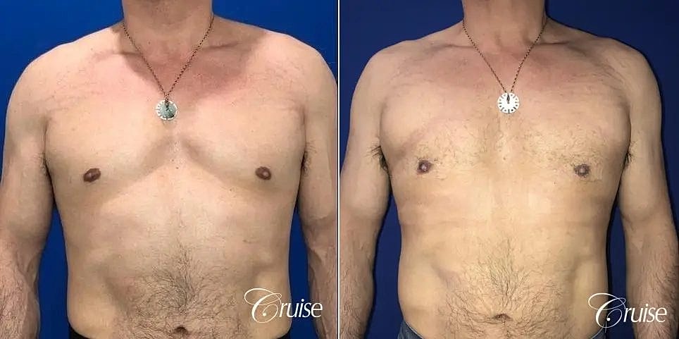 Gynecomastia Surgery Before & After
