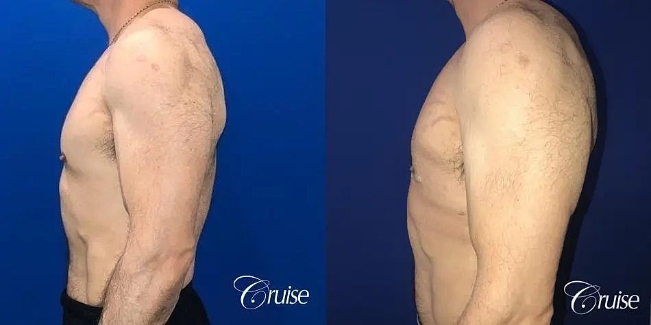 Gynecomastia Surgery Before & After