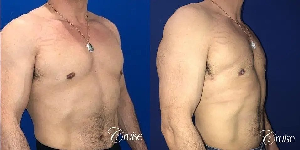 Gynecomastia Surgery Before & After