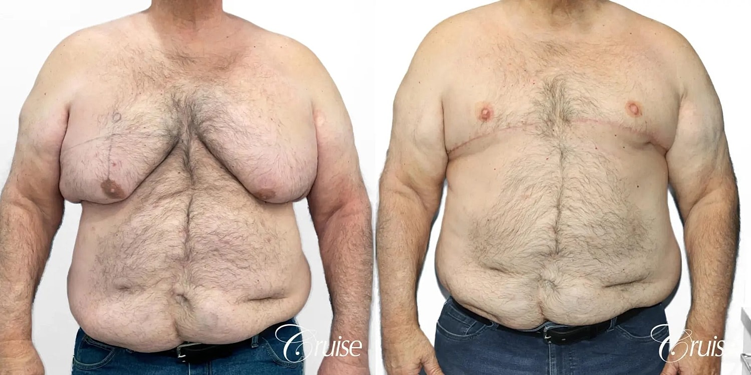 Gynecomastia Surgery Before & After