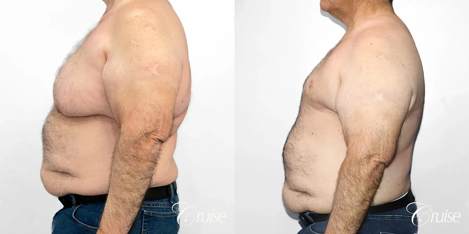 Gynecomastia Surgery Before & After