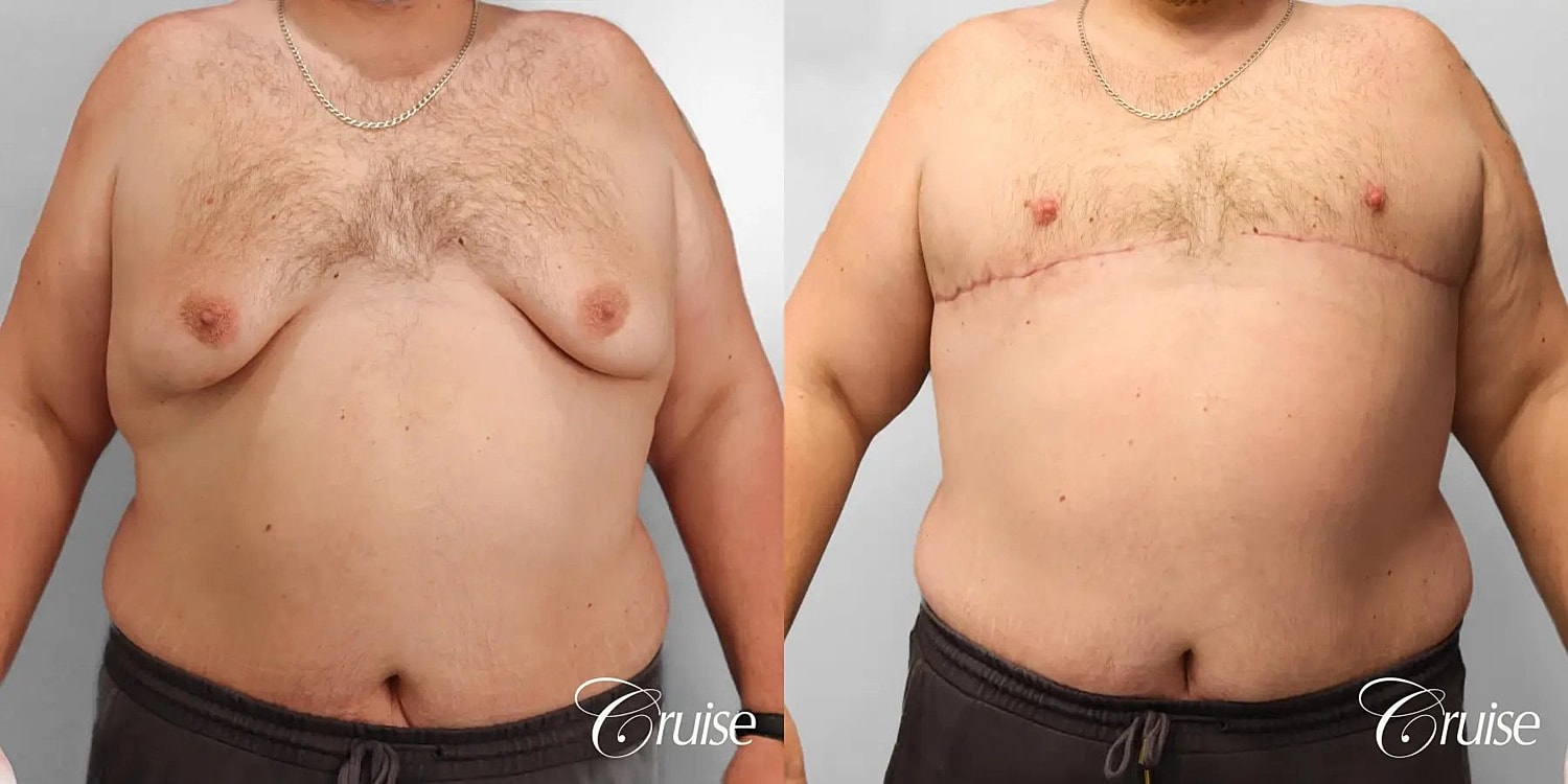 Gynecomastia Surgery Before & After
