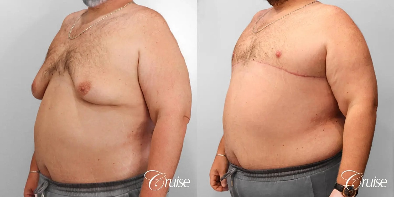 Gynecomastia Surgery Before & After