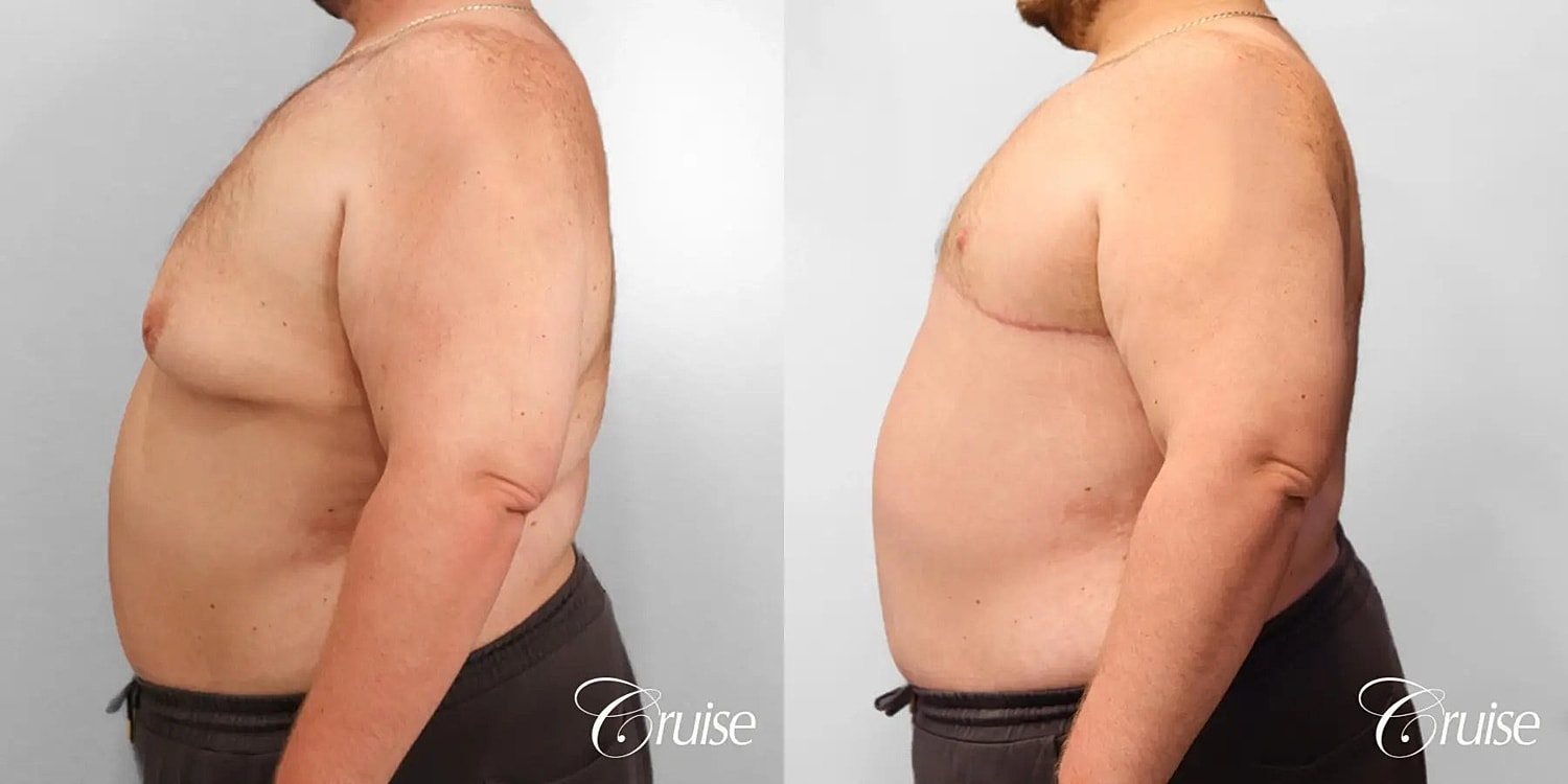 Gynecomastia Surgery Before & After