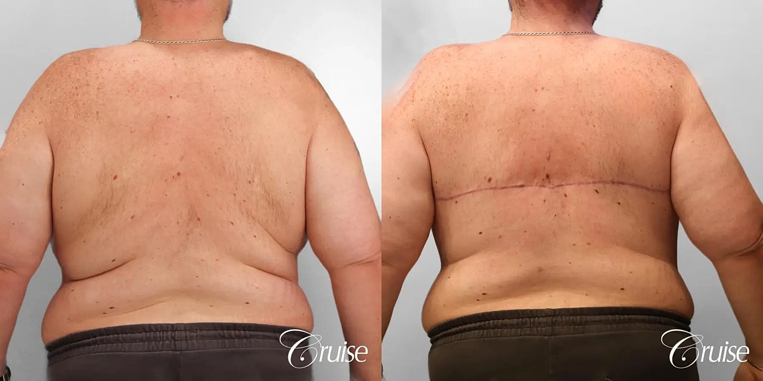 Gynecomastia Surgery Before & After