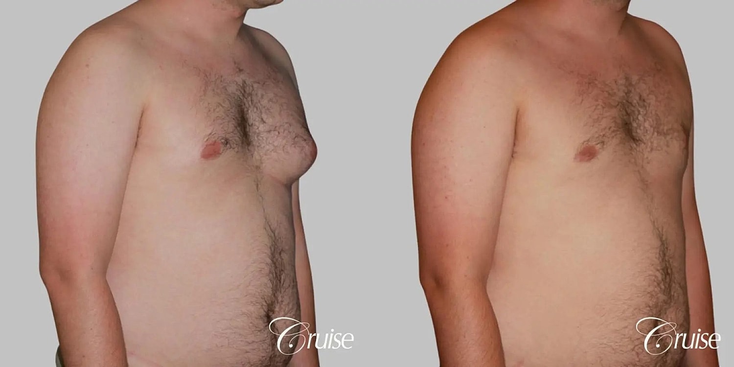 Gynecomastia Surgery Before & After