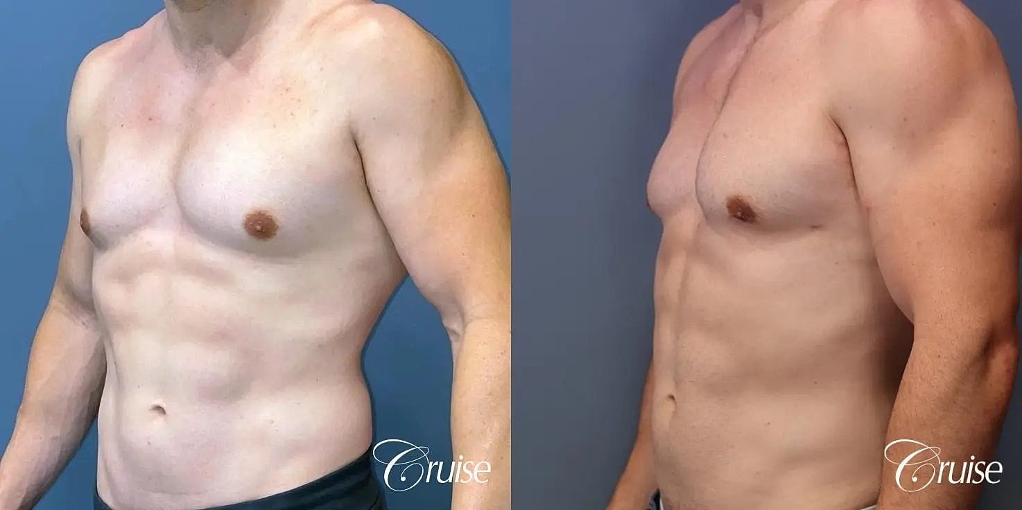 Gynecomastia Surgery Before & After