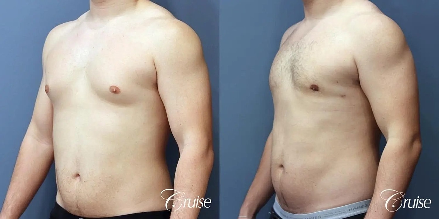 Gynecomastia Surgery Before & After