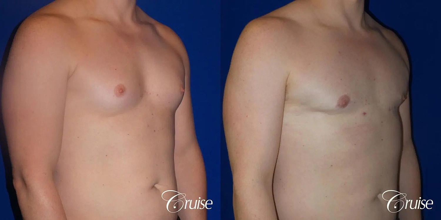 Gynecomastia Surgery Before & After