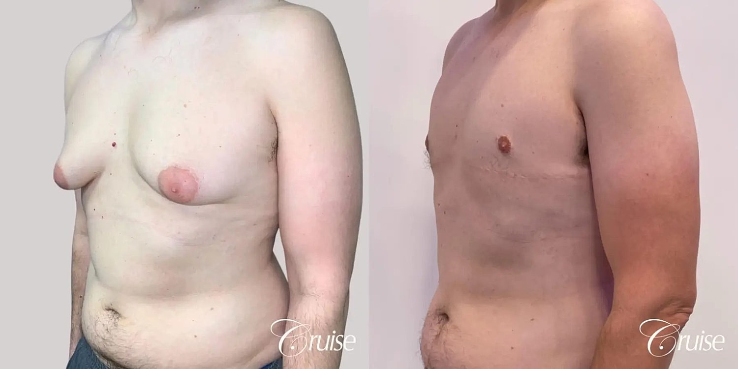 Gynecomastia Surgery Before & After